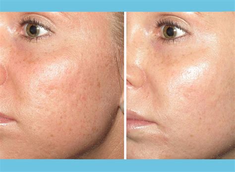 microneedling_before_after_blog1 - Denver Skin Care