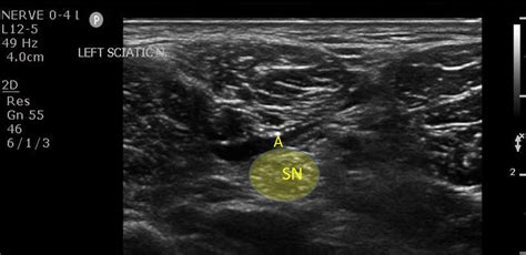 Popliteal Sciatic Nerve Block | EM Ultrasound Section