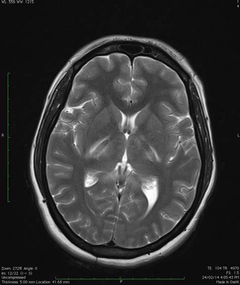 MRI showing bilateral internal capsule involvement. | Download Scientific Diagram