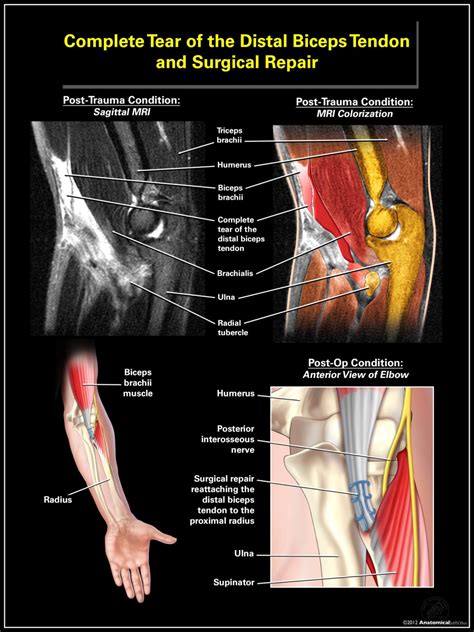 Complete Tear of the Distal Biceps Tendon and Surgical Repair