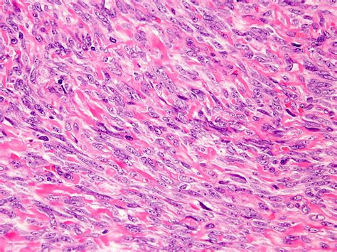 Synovial Sarcoma Histology