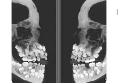 X-ray of baby teeth : r/oddlyterrifying