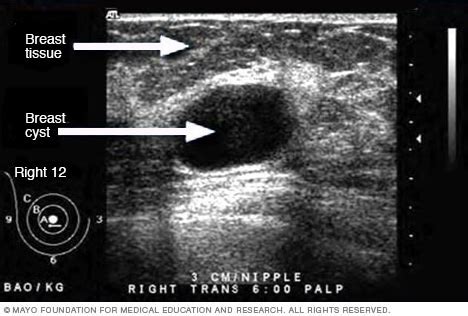 Ultrasound of breast cyst - Mayo Clinic