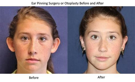 Otoplasty Seattle| Ear Pinning Surgery Kirkland | Dr Windle – DR. BRIAN WINDLE