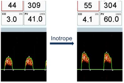 Preload, Afterload and Contractility