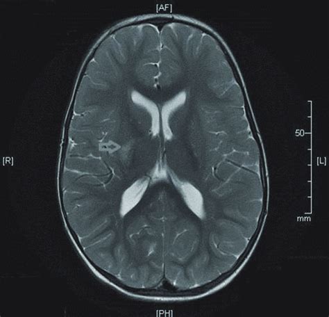 MRI of the brain showing an infract in the region of the internal capsule. | Download Scientific ...