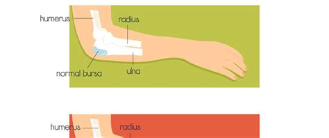 The Management and Treatment for Student’s Elbow or ‘Olecranon Bursitis’ - Prohealth365