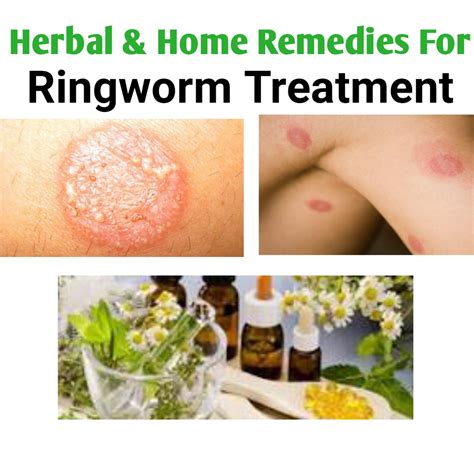 Best Home Remes For Scalp Ringworm - Homemade Ftempo