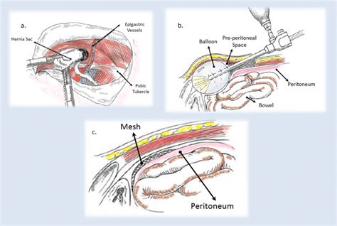 Laparoscopic Inguinal Hernia Surgery Anatomy