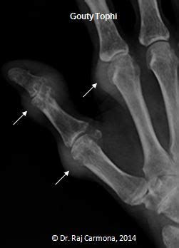 Gout: Overview of X-Ray Findings · RheumTutor