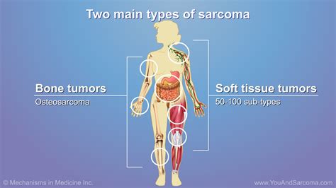 Understanding Soft Tissue Sarcoma