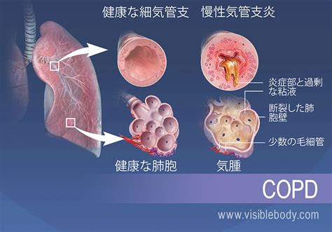 呼吸器疾患および障害