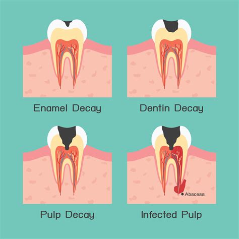 digital image of stages of tooth decay | Dentist Denver & Lone Tree