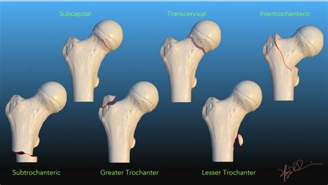 Subcapital Left Femoral Neck Fracture