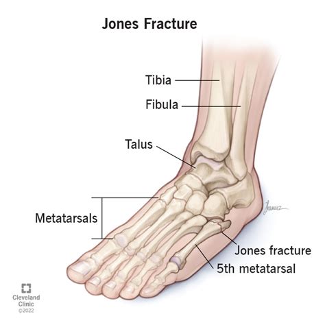 Metatarsal Fracture Swelling