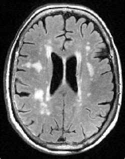 white matter disease mri Mri lesions diffuse axial - Diseases Club center