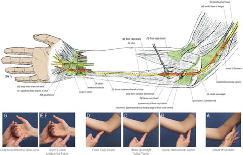 Ulnar Nerve Transposition, 54% OFF | www.micoope.com.gt