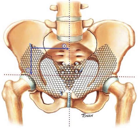 Inguinal Hernia Repair Mesh