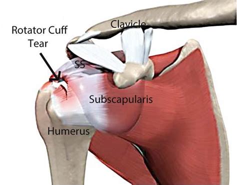 Rotator Cuff Tears and Repairs: Midwest Center for Joint Replacement: Hip and Knee Replacement ...