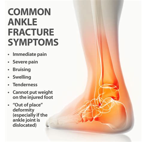 Ankle Fractures Broken Ankle | Florida Orthopaedic Institute