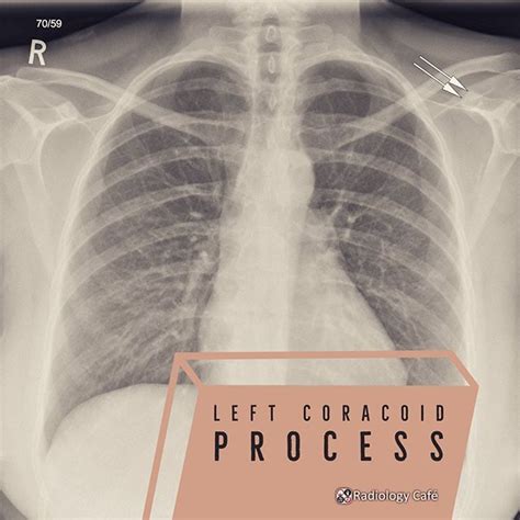 Correct answer: Left coracoid process Share this post in your story! Question from the mock FRCR ...