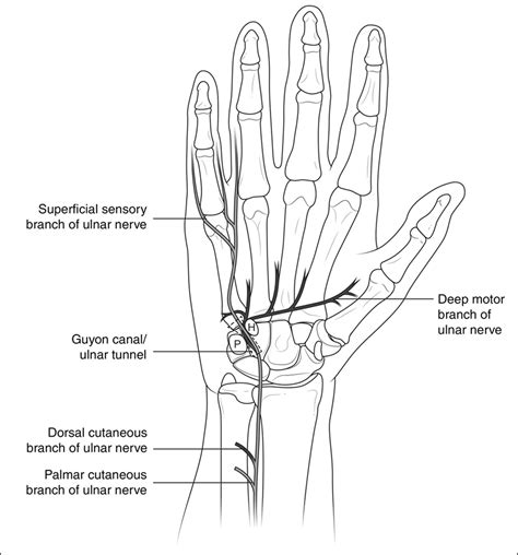 Ulnar Nerve Entrapment