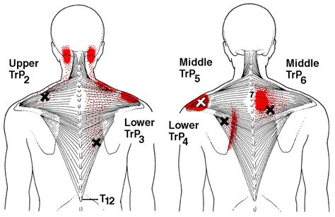 Back Muscle Pain Under Right Shoulder Blade Burning Pain Between Your Spine And Shoulder Blade ...