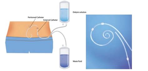 Peritoneal Catheter For Dialysis