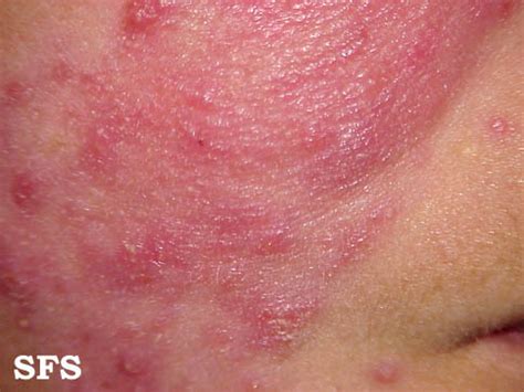 Rosacea (Red Skin Rash) Causes, Phases, Pictures, Treatment | Healthhype.com