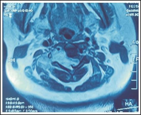 MRI of the patient with synovial sarcoma (image used with permission). | Download Scientific Diagram