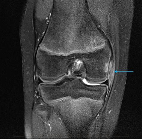 MRI Knee Pediatric MRI Series Clinical Cases & MRI Scans