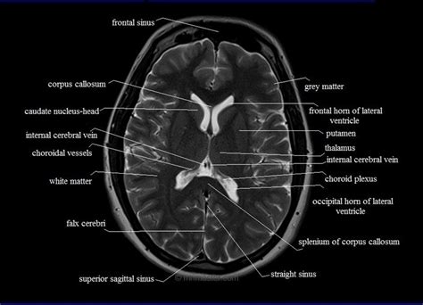 38+ Anatomy Brain On Mri Background