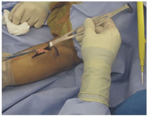 One-Incision Distal Biceps Tendon Repair | Musculoskeletal Key