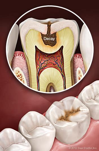 Tooth Decay Prevention | Fu Wong, D.D.S., PA | Maple Grove MN