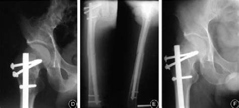 D. X-ray after cannulated nail fixation of femoral neck fracture. E.... | Download Scientific ...