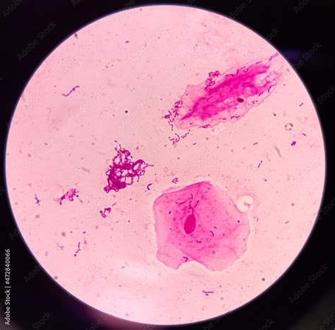 Gram stain microscopic slide, plenty epithelial cells, few pus cells, diplococci and fungal ...