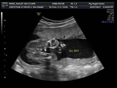 Help! Confusing gender reveal ultrasound! **Update at 20 weeks** - Page 3 - BabyCenter