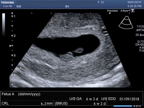 baby moving at 14 weeks ultrasound - Thing Log-Book Custom Image Library