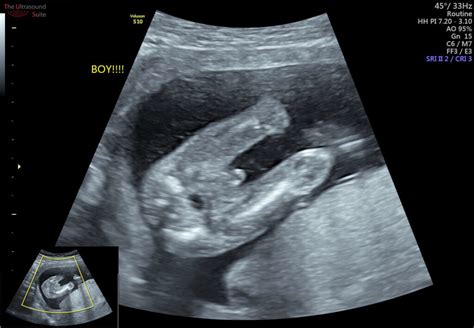 How Early Can I Find Out my Baby's Gender? - The Ultrasound SuiteThe Ultrasound Suite