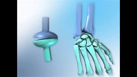 Condyloid Joint Anatomy