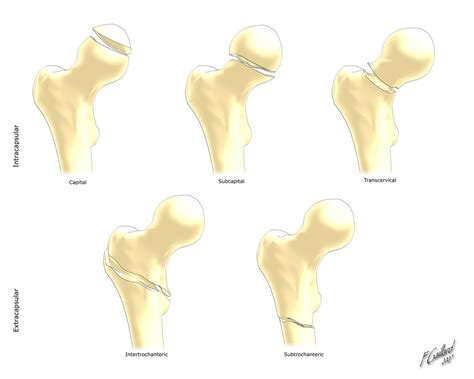 Hip fracture - wikidoc