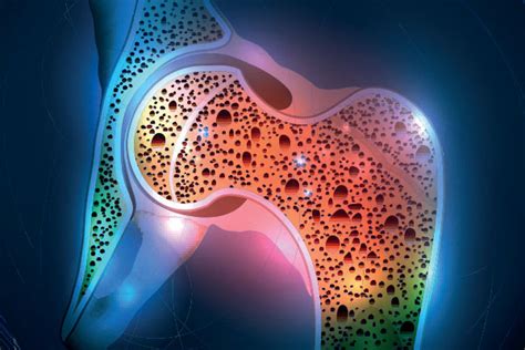 Metabolic Bone Disease and Calcium Disorder - Asheville Endocrinology Consultants