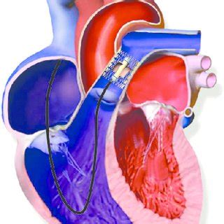 (PDF) Selective reduction of afterload in right heart assist therapy: A mock loop study