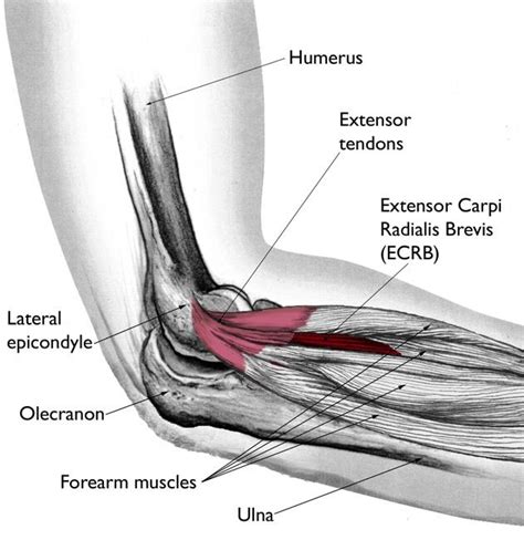 What is tennis elbow treatment? - Quora