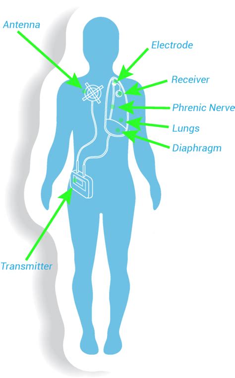 The Avery Diaphragm Pacing System