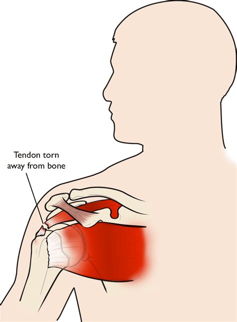 Rotator Cuff Tears - OrthoInfo - AAOS