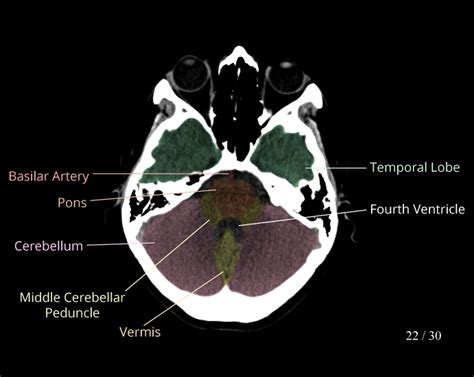 Normal Brain Ct Anatomy