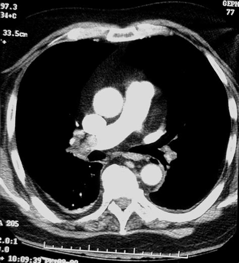 CT Scan Tips & Protocols: CT Pulmonary Angiography