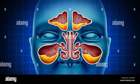 Sinus Infection and Sinusitis illness as a nasal cavity blockage disease with a congested nose ...