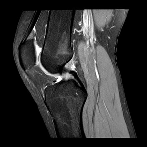 Normal Knee Mri Scan